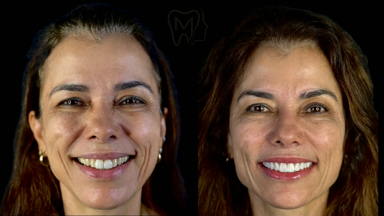 Resultado de tratamento com o Dr. Gabriel F. Meneguzzo, antes e depois